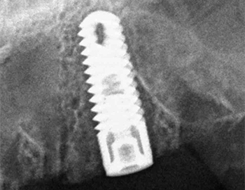 Implantes Dentales en León
